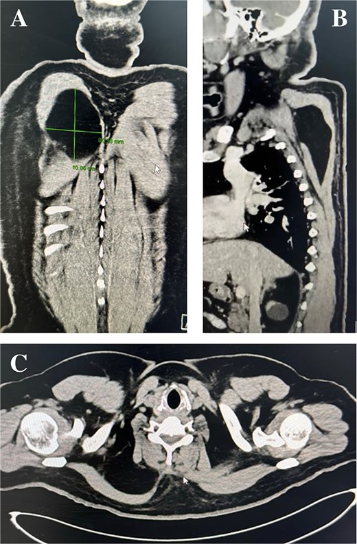 Computed tomography scan: Coronal, sagittal, and axial planes of the lipoma.