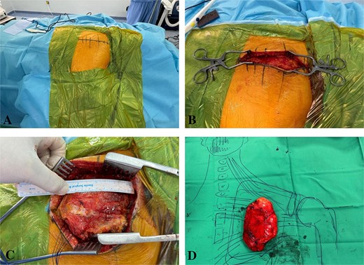 Intraoperative imaging: Marking the incision, exposing the periscapular muscles, dissecting the lipoma, and displaying it over a drawn figure of the anatomy.