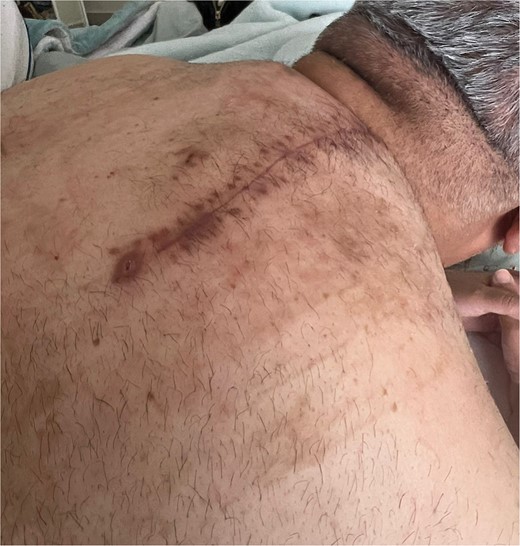 Postoperative imaging: Fully healed surgical incision.