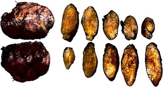 Pathological assessment: Gross images of the specimen before and after dissection.