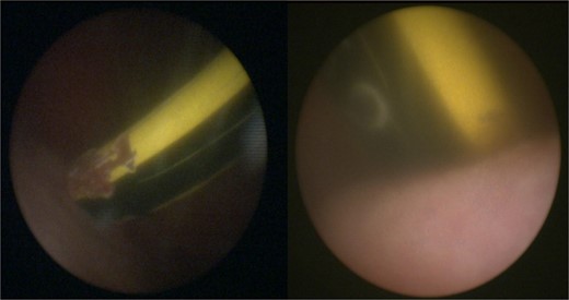 Cystoscopy showing the foreign body in the bladder.