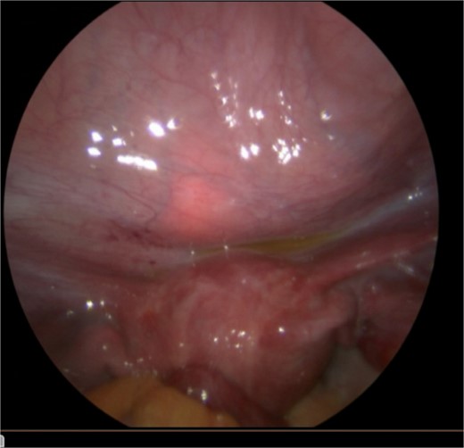 Diagnostic laparoscopy showing no bladder perforation.