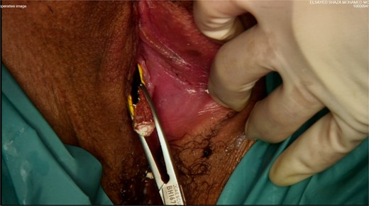 Forceps transurethral removal of the foreign body.