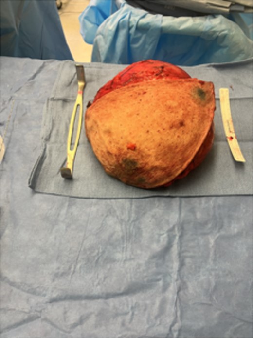 Gross resected breast specimen shows the resected breast mass postoperatively.