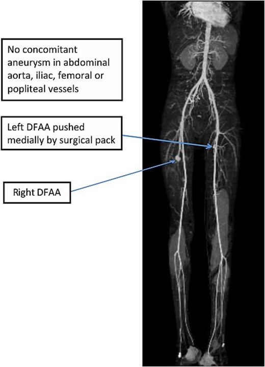 3D-maximum intensity projection frontal view of lower limb CTA showing bilateral DFAA.