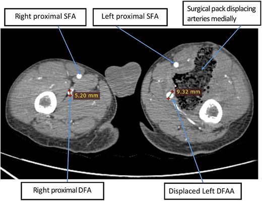 Axial image of lower limb CTA at the level of upper thigh showing left DFAA with maximal diameter of 9.32 mm (anteroposterior diameter of 8.58 mm) with adjacent surgical pack.