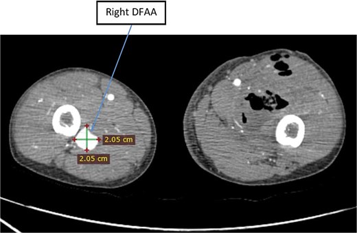Axial image of lower limb CTA showing right unruptured DFAA with concentric aneurysmal sac.