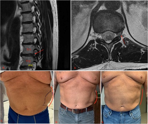First patient’s initial presentation and clinical evolution. (A) An axial view of a CT scan of the abdomen and pelvis revealing a left-sided flank bulge consistent with the patient’s complaint without evidence of hernia. (B, C, D) Left flank bulge at, respectively, 1, 3, and 10 months follow-up, showing a progressive reduction in size (lines). The pictures were given with the patient’s consent.