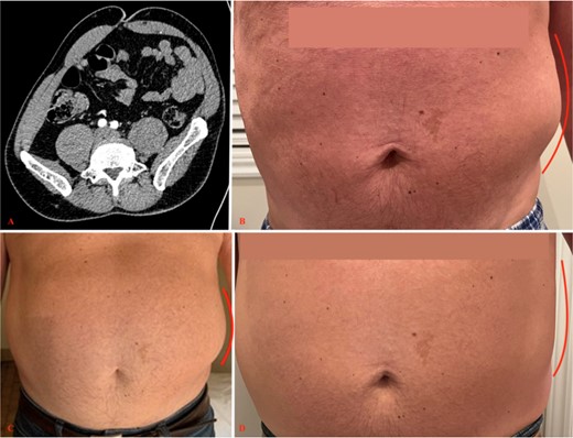 Second patient’s initial scan and clinical evolution. (A) An axial view of a CT scan of the abdomen and pelvis revealing a left-sided flank bulge consistent with the patient’s complaint without evidence of hernia. (B, C, D) Left flank bulge at, respectively, 1, 3, and 10 months follow-up, showing progressive reduction in size (lines). The pictures were given with the patient’s consent.