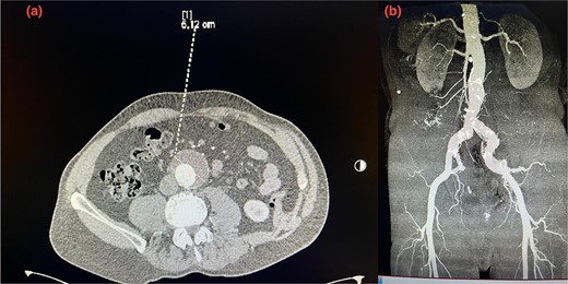 (a) Pre-operative axial CT scan of the infrarenal aorta showing an aneurysm (arrow) measuring 6.10 cm. (b) Initial CTA scan. A detailed anatomy of the bilateral iliac arteries is presented, and the axial image of the CTA demonstrated bilateral common iliac artery ectasia, measuring 2.9 cm on the right side and 2.4 cm on the left side.