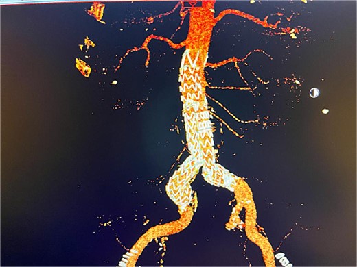 Postoperative 3D reconstruction CTA image of the EVAR without any sign of endo leak.