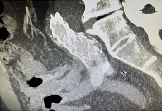 CTA scan showing the floating thrombus distal to the right iliac artery stent, following the patient presenting with acute embolic ischemia in the right leg.