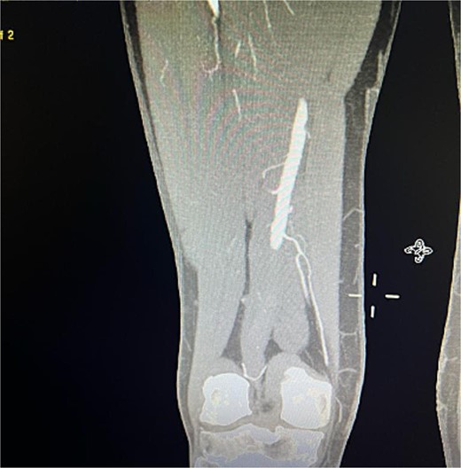 Coronal view of CTA scan showing right femoral artery embolic obstruction