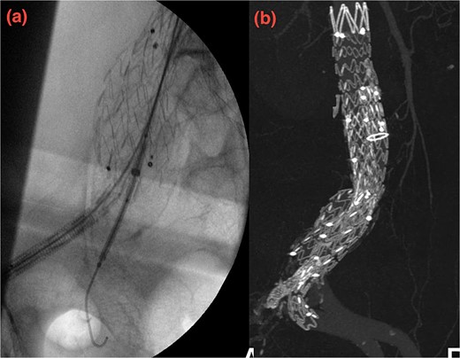 (a, b) Intraoperative images showing implantation of the iliac side branch device ISB.