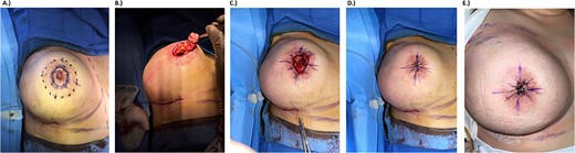 Intraoperative photodocumentation for surgical technique and outcome. (a) Preoperative marking. Solid line shows the portion to be removed, dotted line marks the areolar border. (b) Post-mastectomy removal of nipple. (c) Four-point purse string closure for deep tissue. (d) Eight-point purse string closure for superficial tissue. (e) One month follow-up photo.