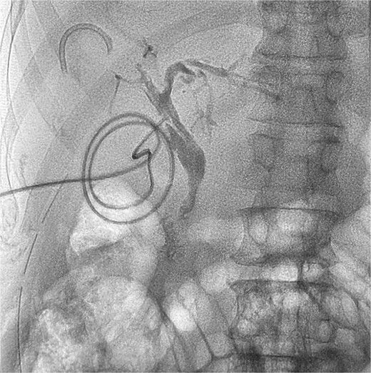 T tube cholangiogram showing a residual fragment of the broken stent in the right anterior sectoral duct.