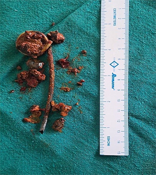 Isolated specimen of intraluminal stent and associated stentoliths.