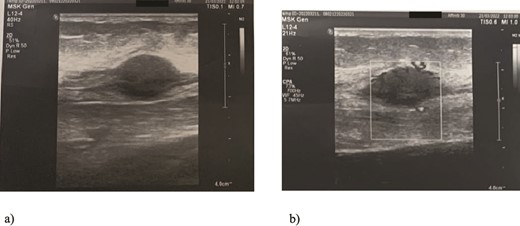 Ultrasound examination of the tumor: Spindle-shaped hypoechogenic and subcutaneously placed mass (a) with marked hypervascularity on color flow mapping (b).