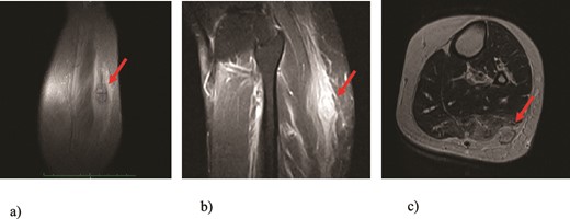 MRI findings of the tumor (arrows): (a) T1 image, coronal view; (b) T2 image, sagittal view; (c) T1 image, axial view revealing presence of a well-defined soft tissue tumor positioned in the subcutaneous fat tissue of the left calf with size of 3 cm and swelling of the surrounding muscles.
