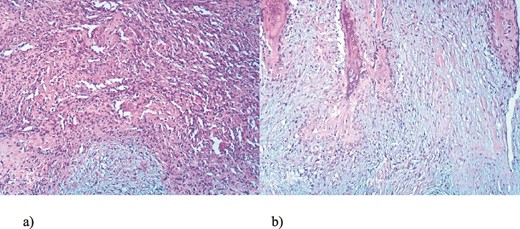 Microscopic appearance of the tumor, He-Eo, ×40.