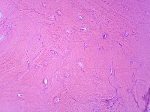 Microscopic appearance, from the biopsy of the iliac wing, showing late (sclerotic) phase of Paget disease, He-Eo, ×200.