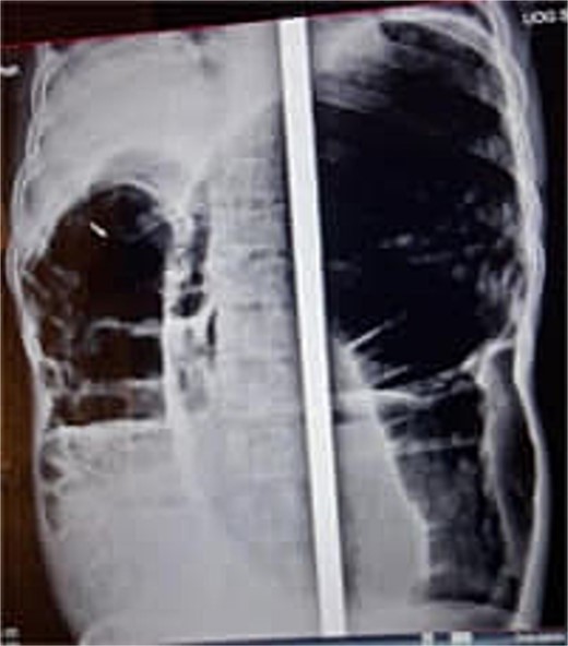 Abdominal X-ray showing dilated colon and multiple air-fluid levels.