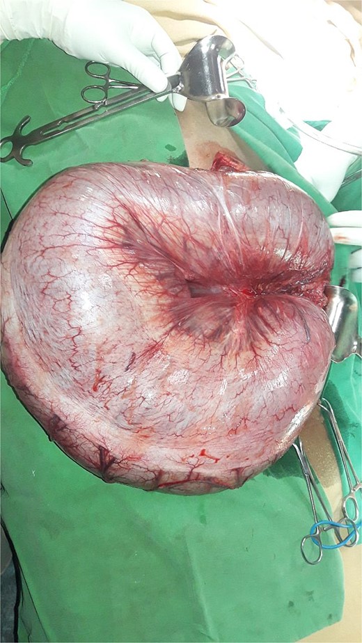 Photograph of descending colon volvulus.