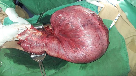 Photograph of the descending colon post-derotation.