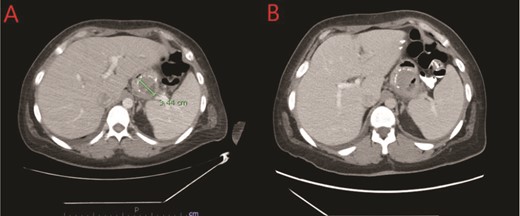 (A) CT showing a complex fluid collection at the proximal greater curvature of the stomach consistent with intramural abscess. (B) Interval improvement in complex fluid collection after endoscopic stent removal.