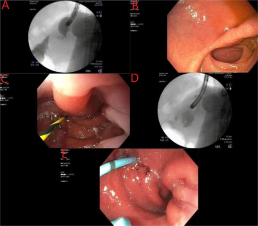 Endoscopic evaluation and stent placement into perforation of the gastric cardia. (A) Delayed imaging of UGI series with no extravasation of contrast. (B) Widely patent duodenal switch lumen. (C) Wire being placed into the fistula tract of the gastric cardia. (D) Contrast filling into the identified abscess cavity. (E) Placement of a double lumen stent through the fistula into the abscess cavity.