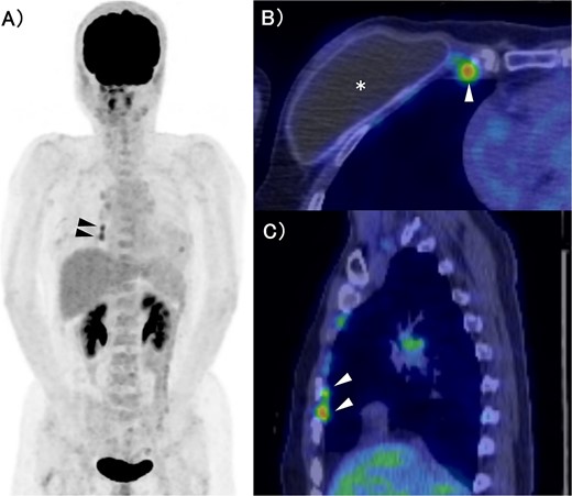 FDG-PET/CT. (A) MIP section. (B) Horizontal section. (C) Sagittal section. The asterisk and arrow indicate the artificial breast implant and IMs, respectively. FDG accumulation was observed in the IMs. FDG: Fluorodeoxyglucose, PET: Positron Emission Tomography, CT: Computed Tomography, MIP: Maximum Intensity Projection, IM: Internal Mammary lymph node.
