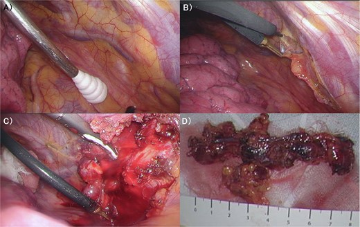 (A) The internal mammary artery and vein can be seen thorough the parietal pleura. (B) The parietal pleura were dissected along the internal mammary artery and vein. (C) En bloc resection of IM from the chest wall was performed. (D) The enlarged IM was widely resected. IM: Internal Mammary lymph node.