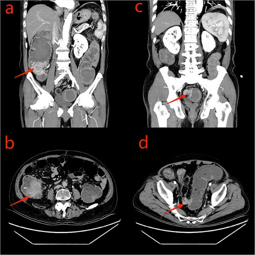 CT scan of the abdomen and pelvis: a: ascending colon tumor (coronal scan); b: cecum tumor (axial scan); c: sigmoid tumor (coronal scan); d: sigmoid tumor (axial scan).