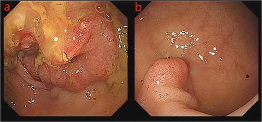 Colonoscopy images: a: sigmoid tumor; b: rectal adenoma.
