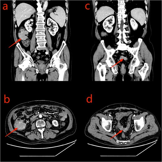 CT scan of the abdomen and pelvis: a and b: ascending colon tumor; c and d: sigmoid tumor.