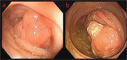 Colonoscopy images: a: sigmoid tumor; b: ascending colon tumor.