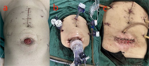 Pictures of the surgery: a: preoperative; b: intraoperative; c: postoperative.