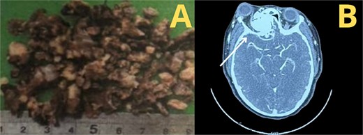 (A) Macroscopic examination of ossifying fibroma, (B) CT.