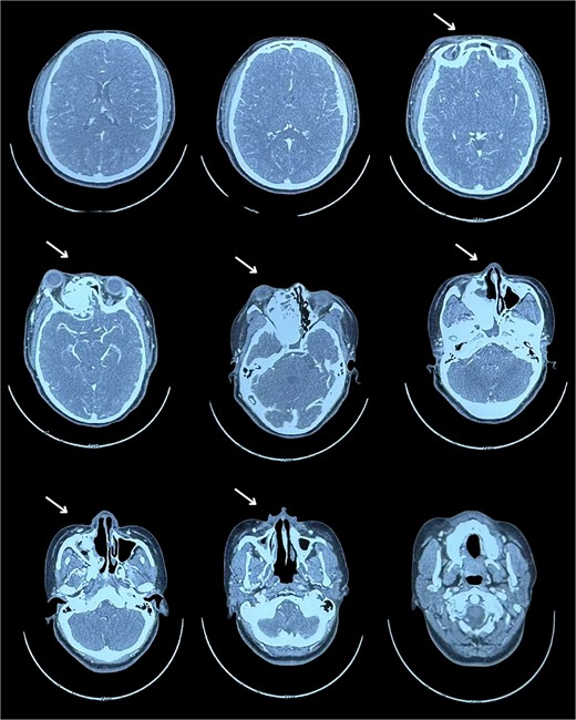 Ossifying fibroma lateral right eye displacement.