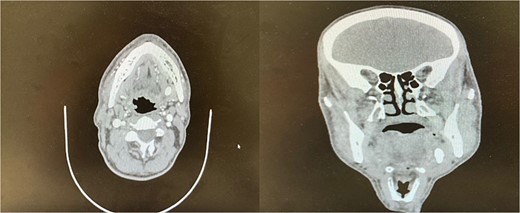 Preoperative coronal and axial CT images showing a sialolith within the submandibular gland.