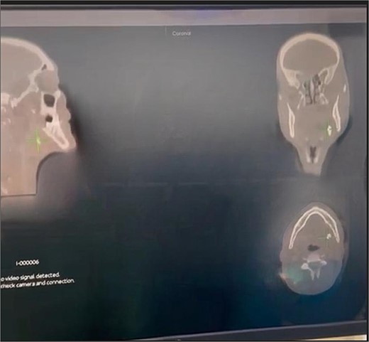 Intraoperative navigation identifying the location of the sialolith.