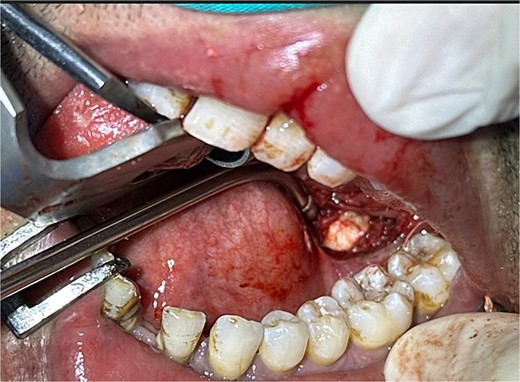 Intraoral extraction of the submandibular gland stone during the procedure.