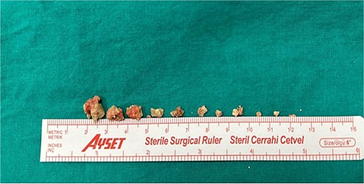 Fragments of the submandibular gland stone extracted during surgery.