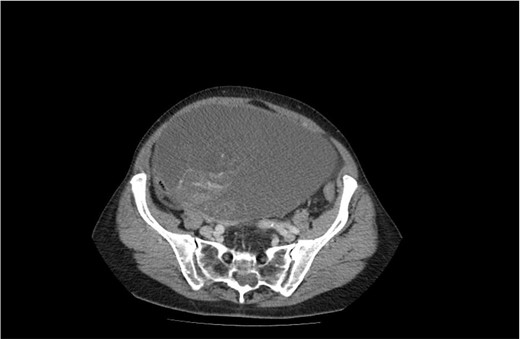 CT image of a large ovarian mucinous cystadenoma of the left ovary.