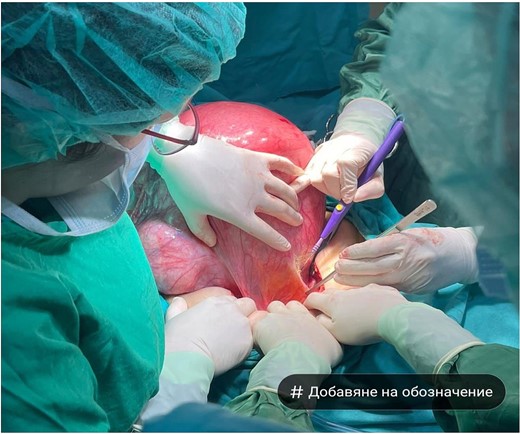 Macroscopic view of a large cystadenoma of the left ovary—lower median laparotomy.