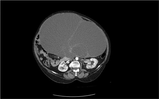 CT image of a mucinous cystadenoma of the left ovary.