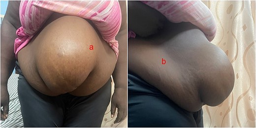 Showing the anterior (a) and lateral (b) views of the preoperative state of the woman.