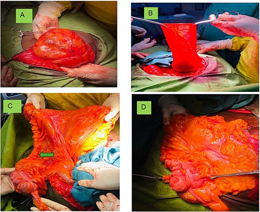 Showing (a) the incision unveiling the content covered with the sac; (b) the hernia sac; (c) the appendix (Blue arrow), PAM and colon (arrow head) continuing with the transverse colon; and (d) excessive fat on the mesentery.