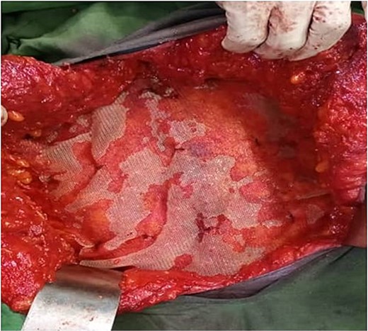 Showing the onlay 30 × 30 cm polypropylene mesh in-situ.