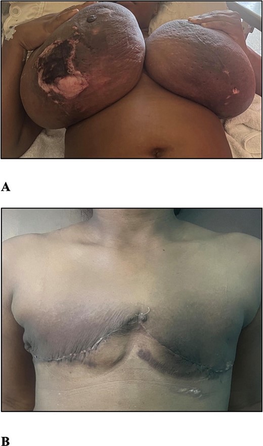 (A) The photograph shows bilateral gestational gigantomastia R > L with skin changes. (B) The photograph shows the patient 1 month post bilateral simple mastectomies.
